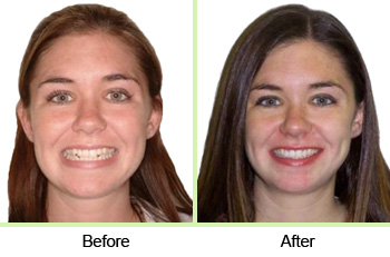 Invisalign results