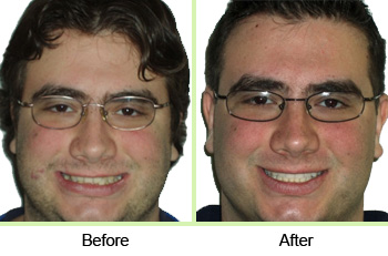 Invisalign results